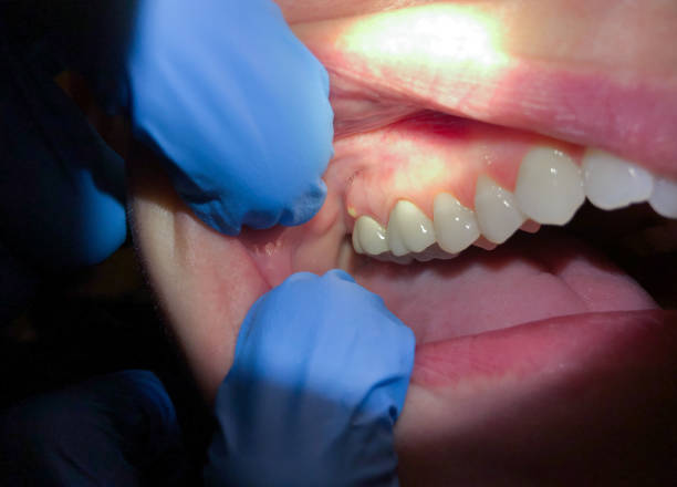 Best Emergency Treatment for Dental Infections or Abscesses in Fountain Green, UT